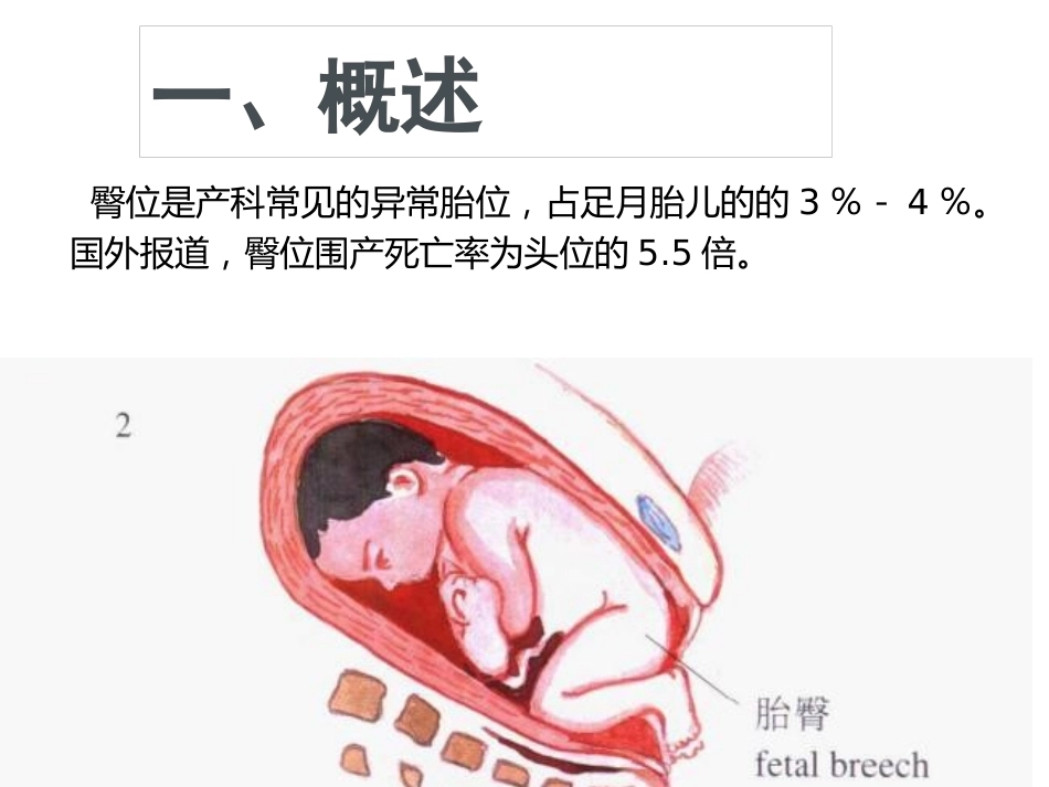 臀位分娩_第2页