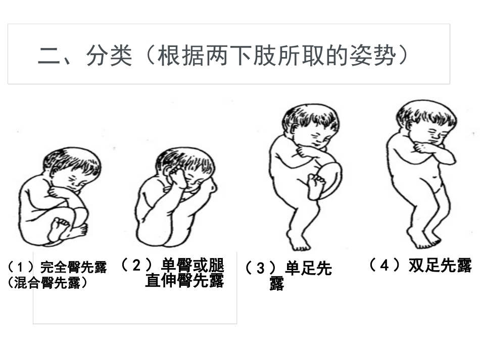 臀位分娩_第3页
