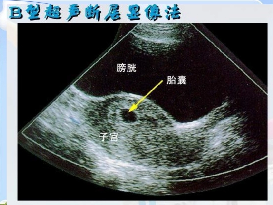 妊娠诊断最新_第12页