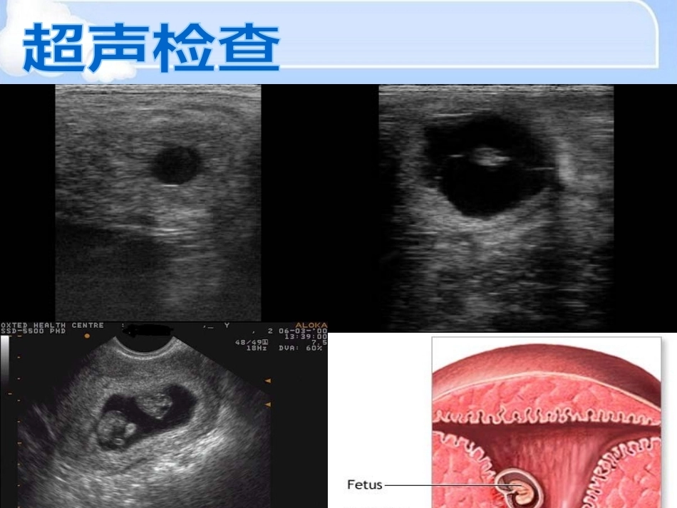 妊娠诊断最新_第13页