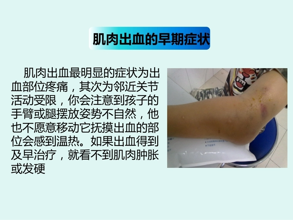 血友病儿童出血的预防与护理_第15页