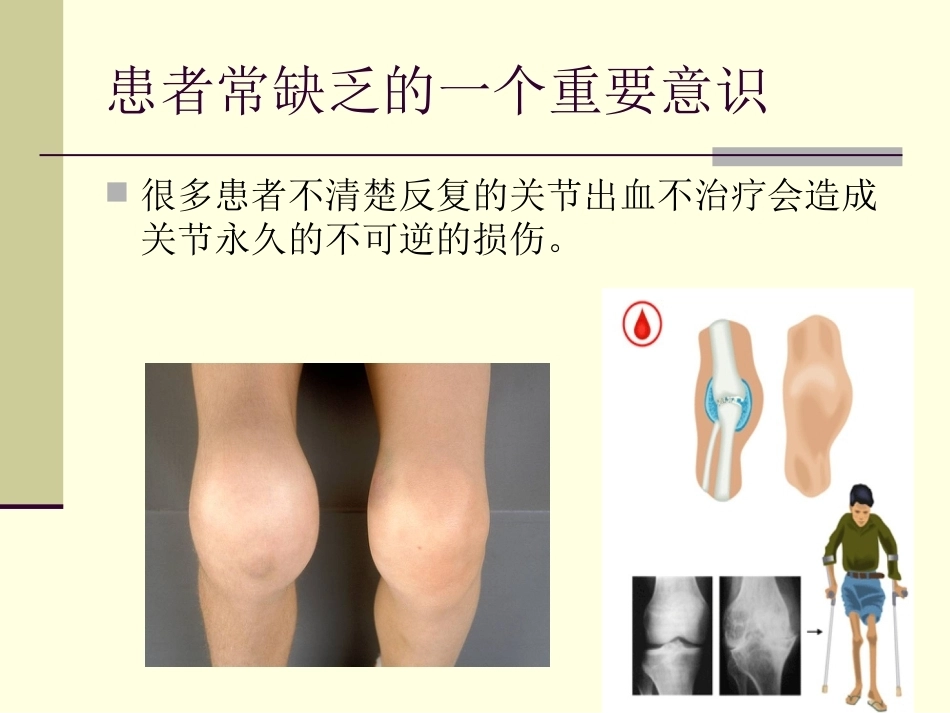 血友病护理技能_第12页
