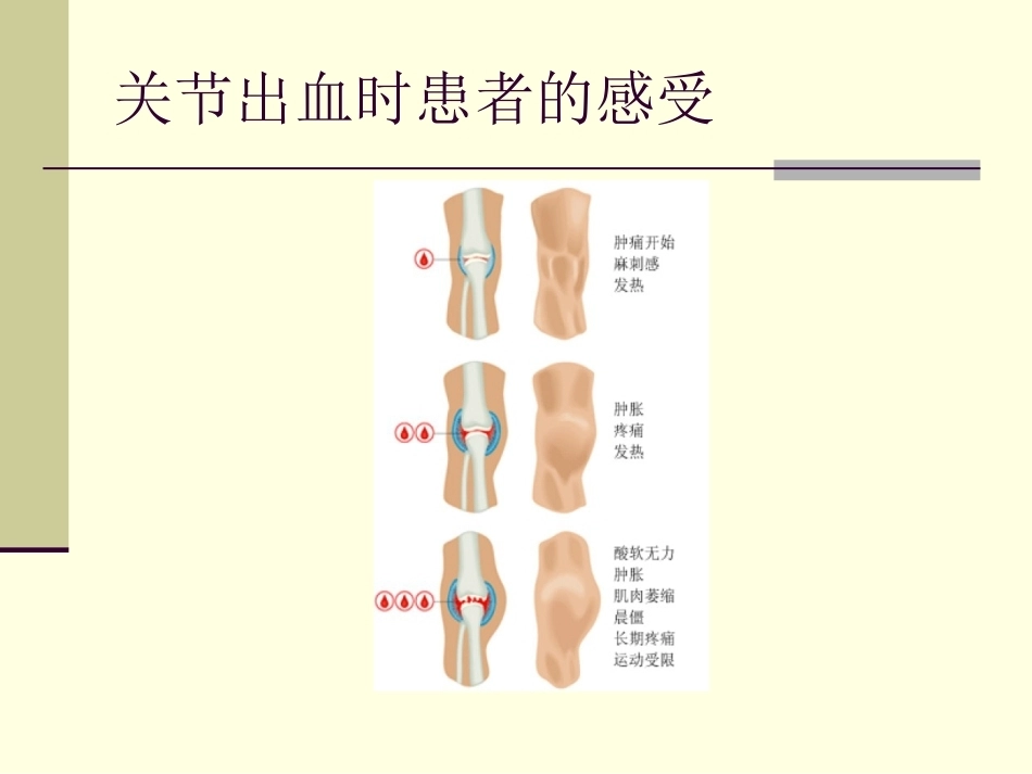 血友病护理技能_第8页