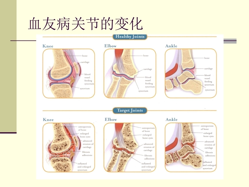 血友病护理技能_第9页