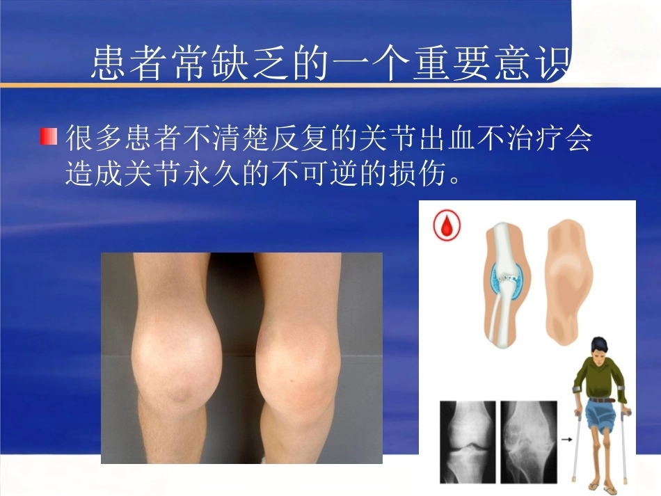 血友病护理技能-2_第12页