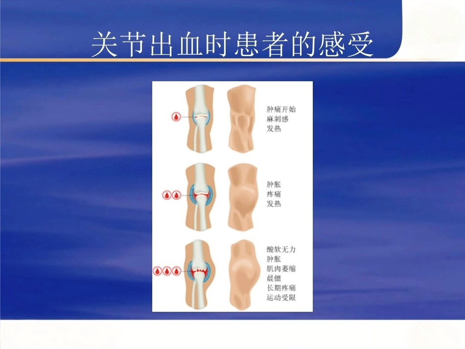 血友病护理技能-2_第8页