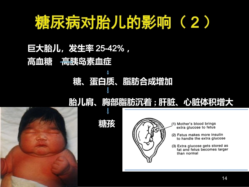 妊娠期糖尿病诊断标准_第14页