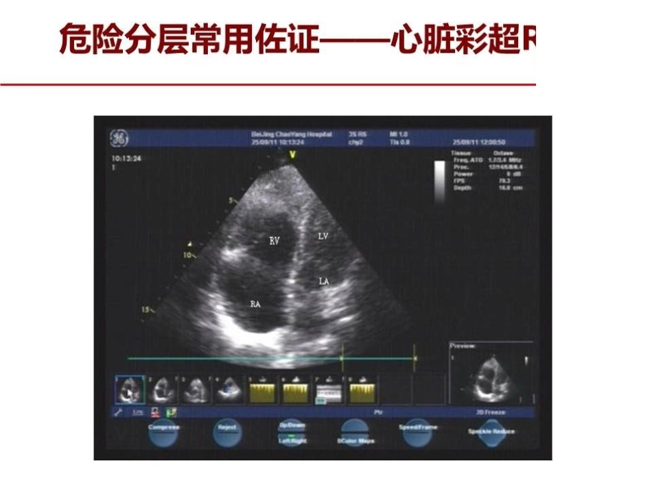 危险分层：如何进行肺栓塞严重程度评估指导决策？_第6页