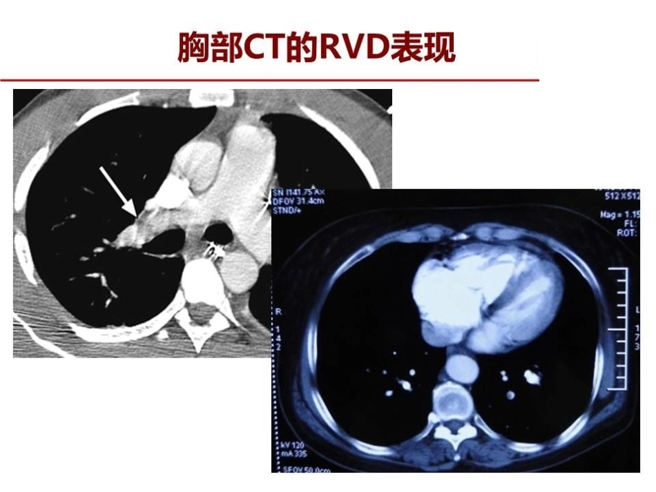 危险分层：如何进行肺栓塞严重程度评估指导决策？_第7页