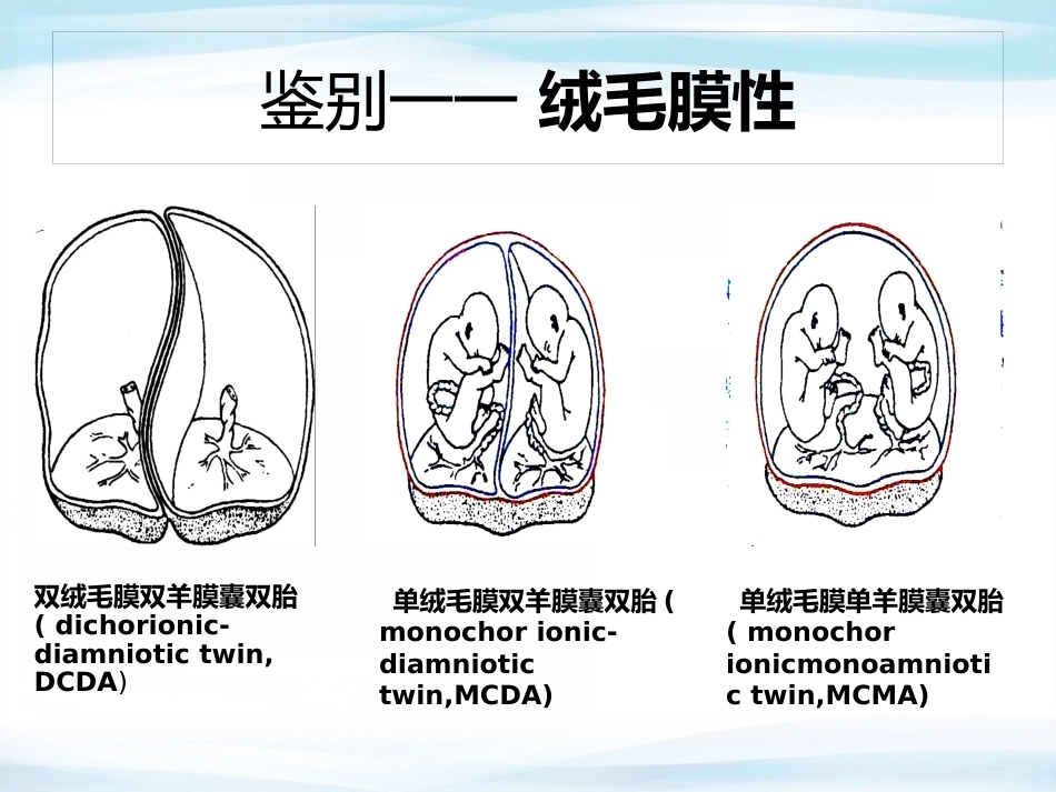 双胎妊娠 查房_第7页
