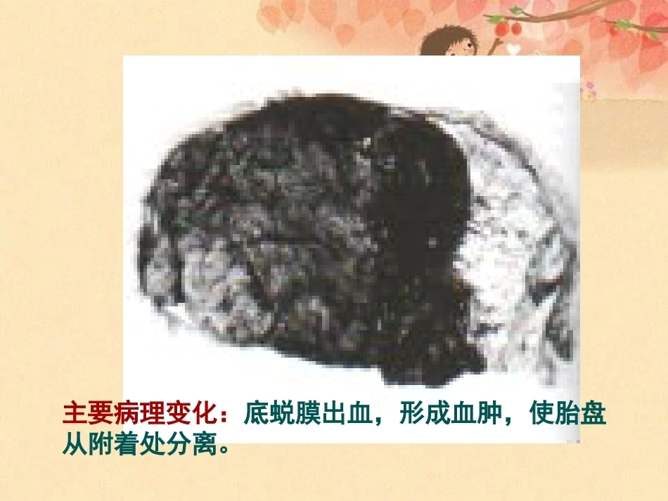 妊娠晚期出血_第8页