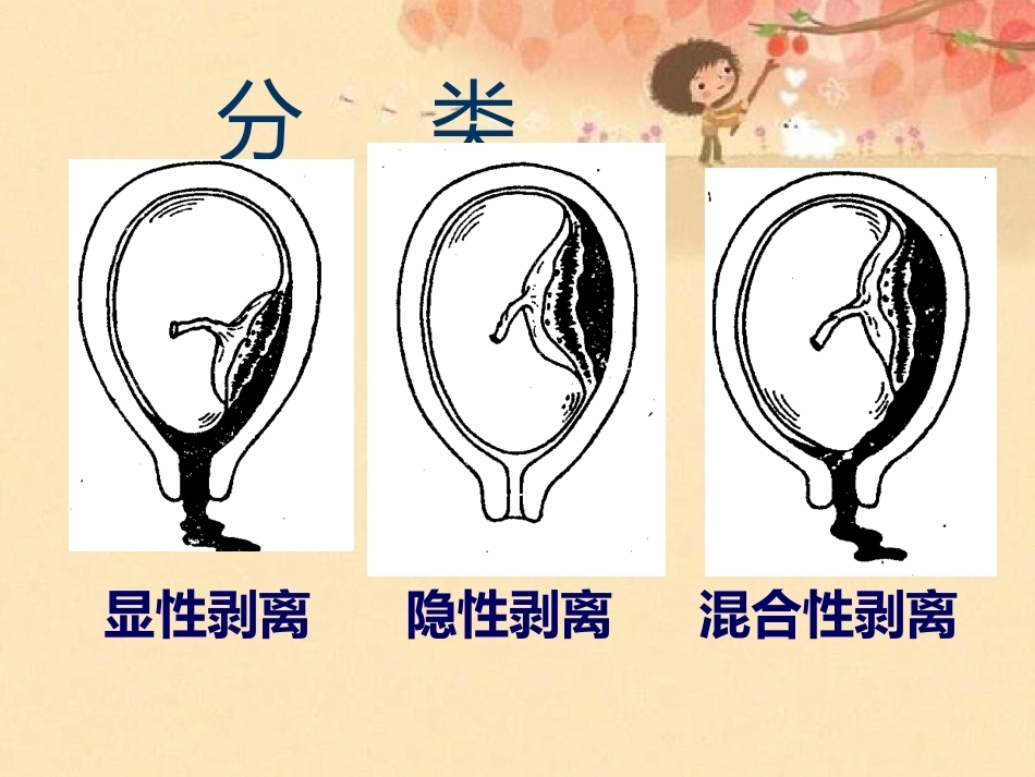 妊娠晚期出血_第9页