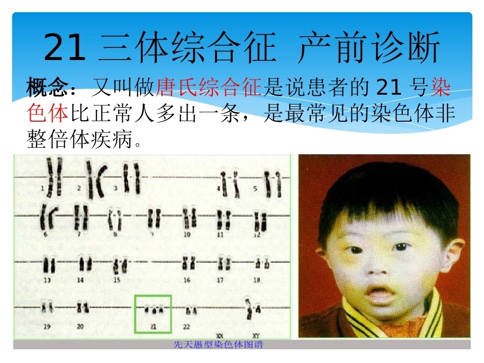 三体综合征 产前诊断_第2页