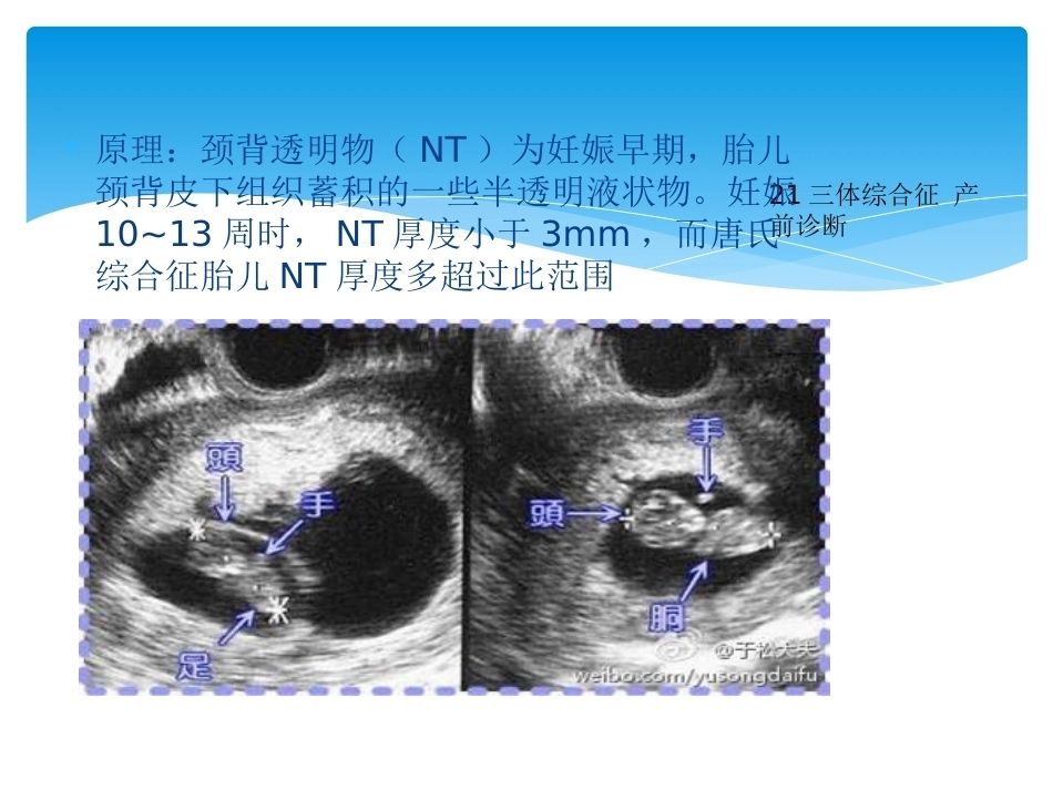 三体综合征 产前诊断_第5页