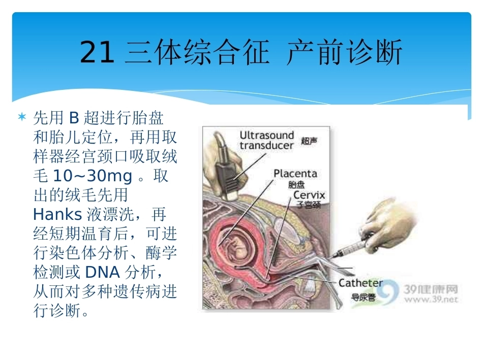 三体综合征 产前诊断_第7页