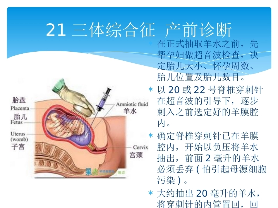 三体综合征 产前诊断_第8页