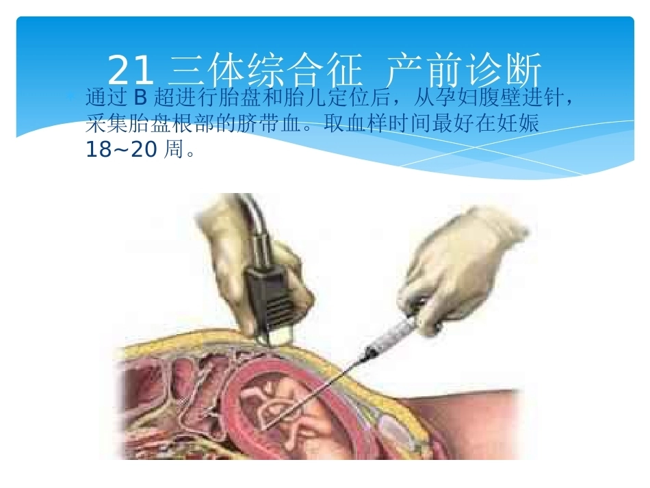 三体综合征 产前诊断_第9页