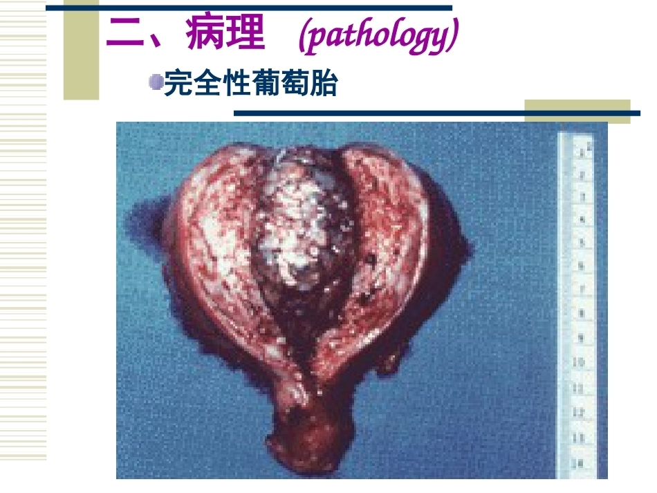 妊娠滋养细胞疾病2_第14页