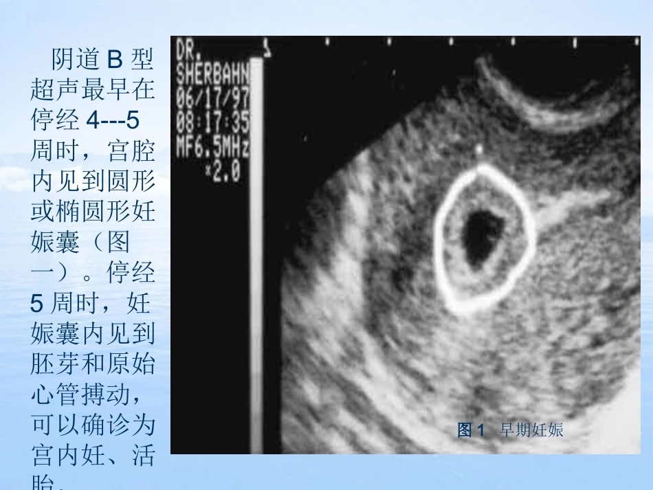妊娠滋养细胞疾病2_第2页
