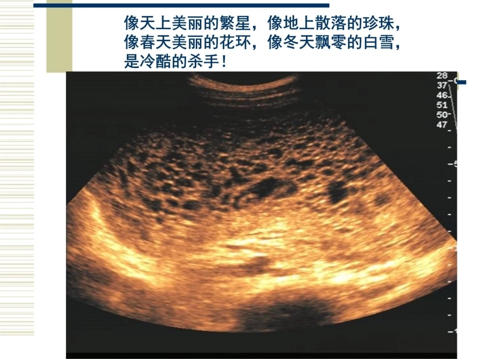 妊娠滋养细胞疾病2_第4页