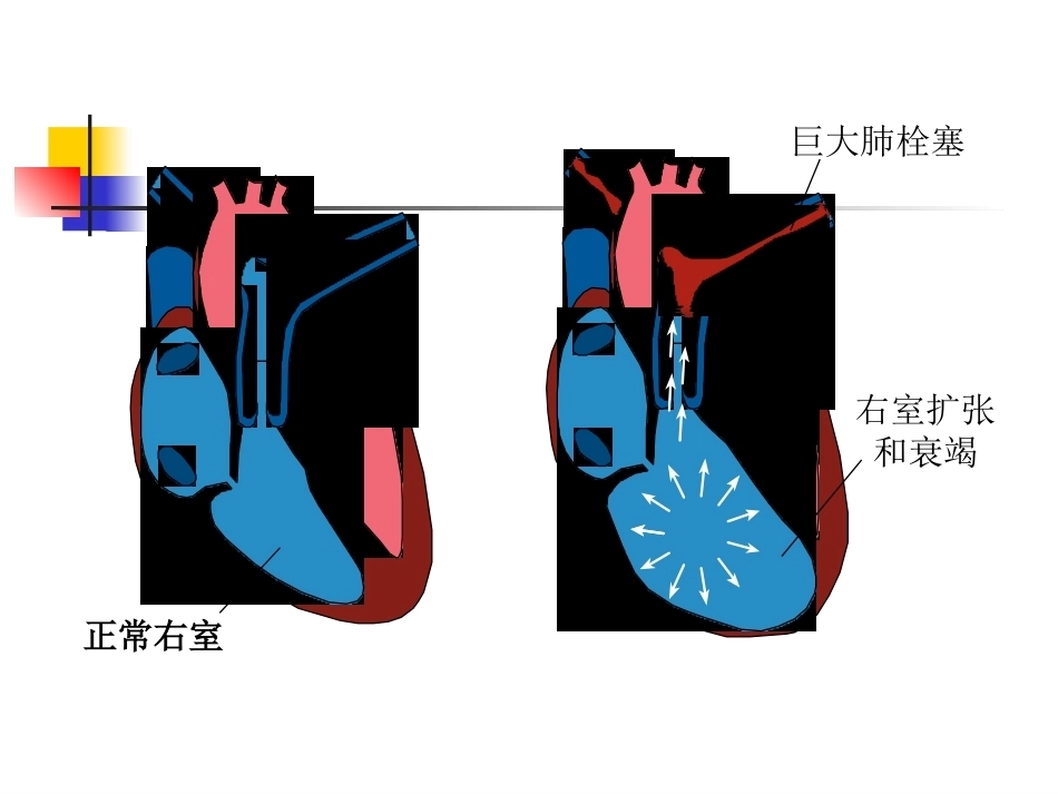 围术期肺栓塞的处理及预防2_第6页