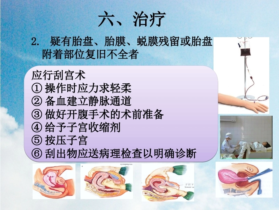 晚期产后出血2_第11页