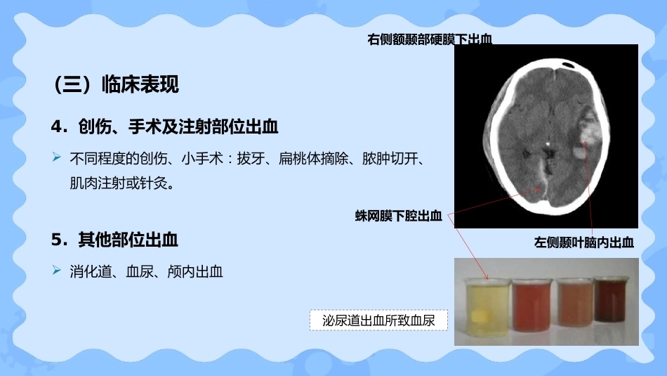 小儿血友病_第13页
