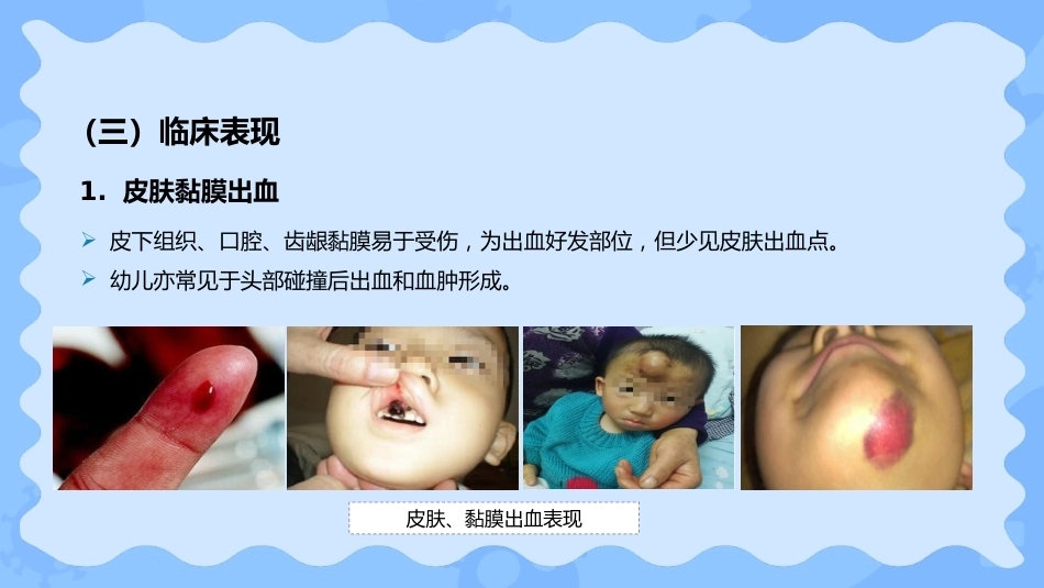 小儿血友病_第9页