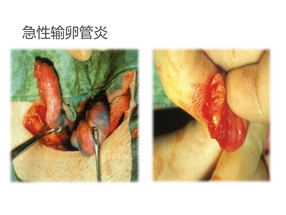 异常产褥妇产科学2_第11页