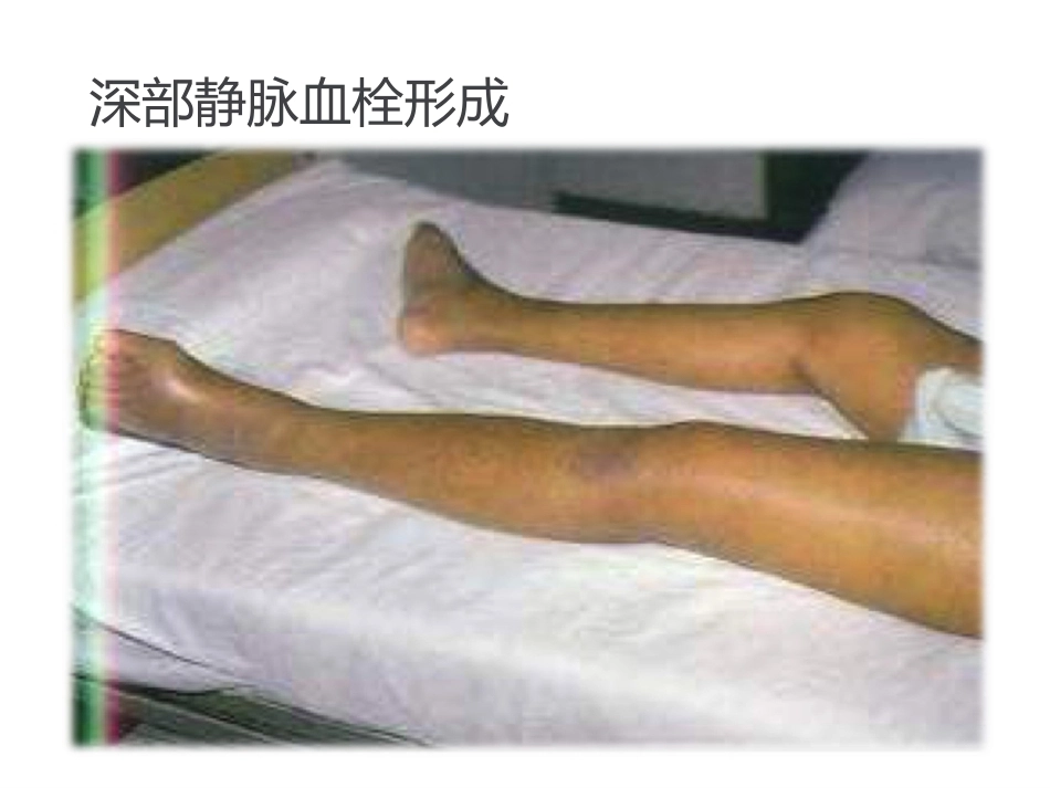 异常产褥妇产科学2_第12页