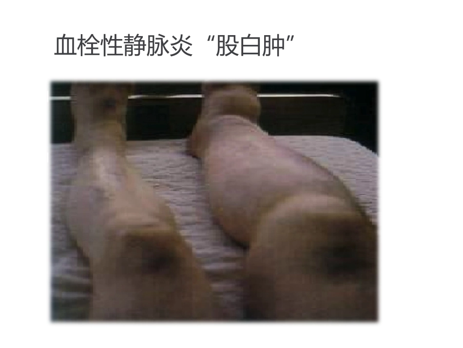 异常产褥妇产科学2_第13页