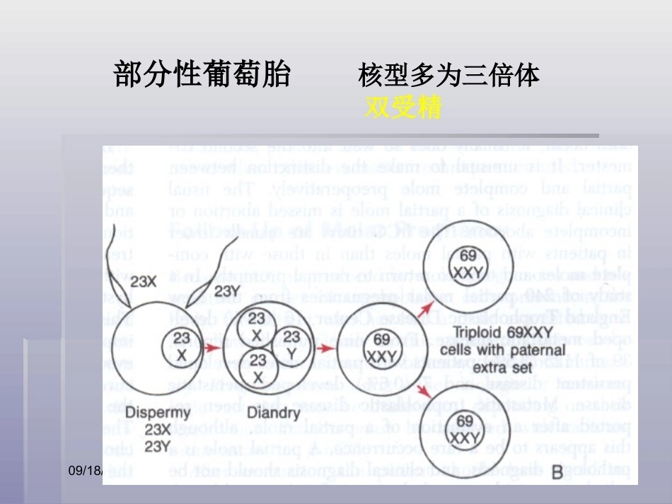 妊娠滋养细胞疾病4_第13页
