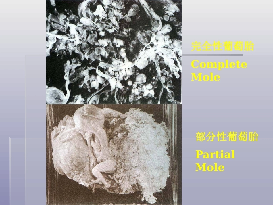 妊娠滋养细胞疾病4_第7页