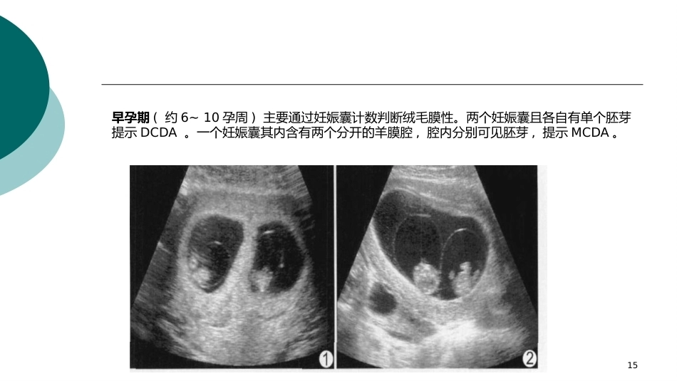 双胎妊娠ppt课件4_第15页