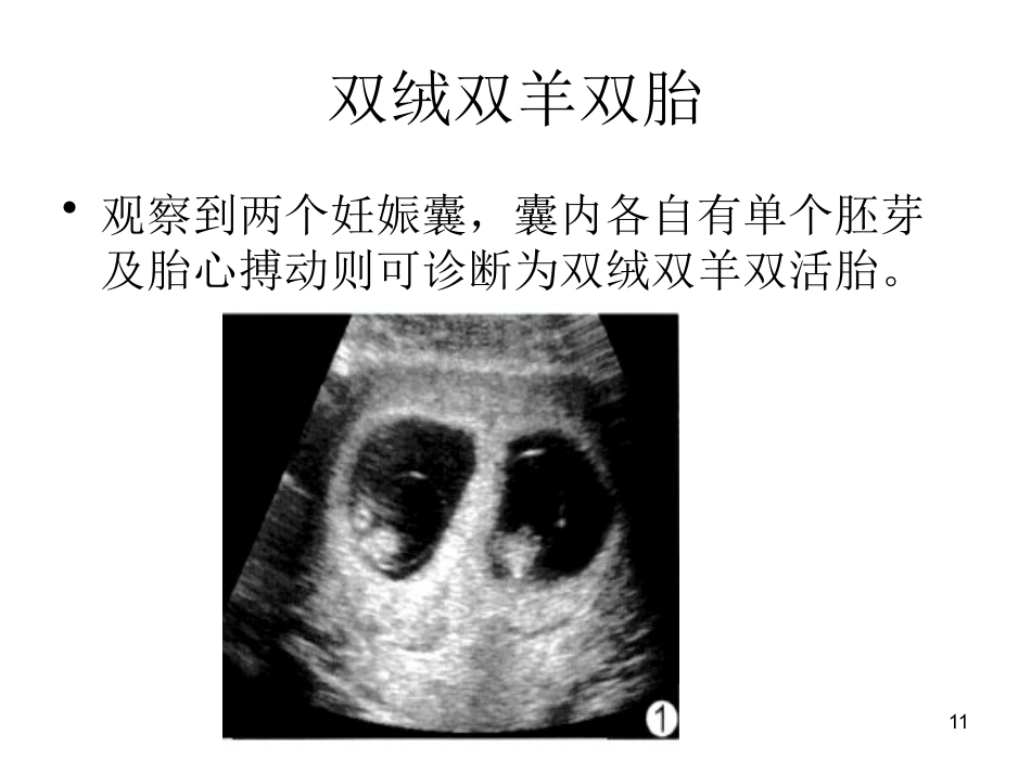 双胎妊娠超声诊断7_第11页