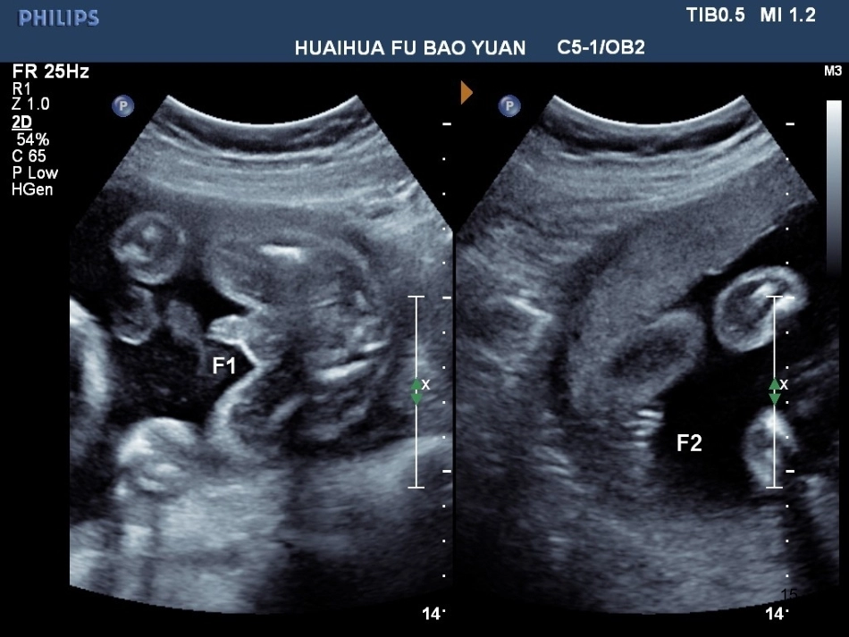 双胎妊娠超声诊断7_第15页
